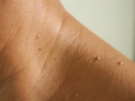 Dealing With Unsightly Warts – Miss Baby Sol