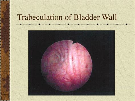 PPT - Endoscopy and Radiology for Lower Urinary Tract Dysfunction ...