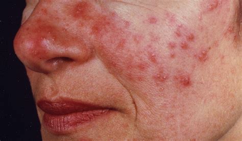 New Study Examines Differences Between Rosacea and Acne | Rosacea.org