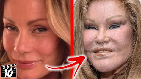 Top 10 Celebrities With Terrible Plastic Surgery Youtube - Vrogue