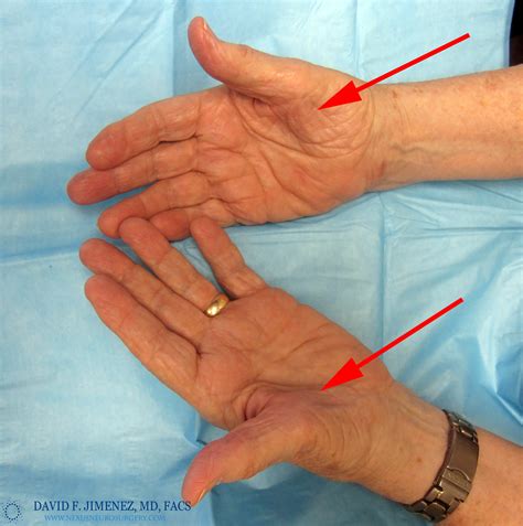 Carpal tunnel syndrome symptoms - molipod