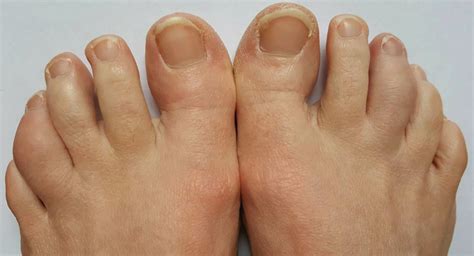 Case Report: A Psoriatic Arthritis Patient with Dactylitis & Enthesitis - The Rheumatologist