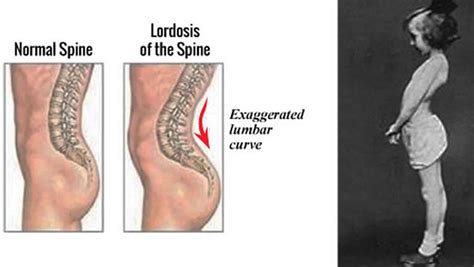 Lordosis definition, causes, symptoms, diagnosis and lordosis treatment