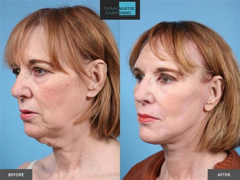 8 Facelift Before-and-After Photos That Prove Just How Natural Today’s Results Look | TLKM ...