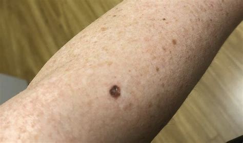 Melanoma in Situ – What is it and How did it affect me?