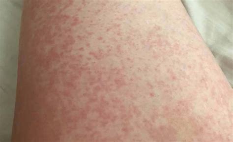 Sepsis Skin Rash