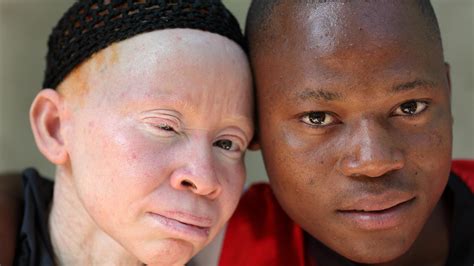 Stop aux idées reçues sur l'albinisme ! - AlloDocteurs