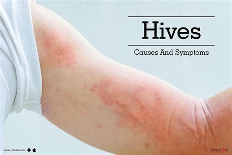 Hives Causes Treatment And Conditions Wiki Itchy Mind Images