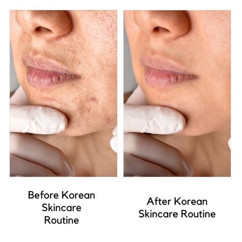 Korean Skincare For Oily Skin: A Comprehensive Guide