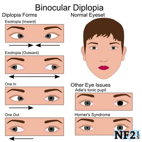 Eye Exercises For Strabismus In Adults