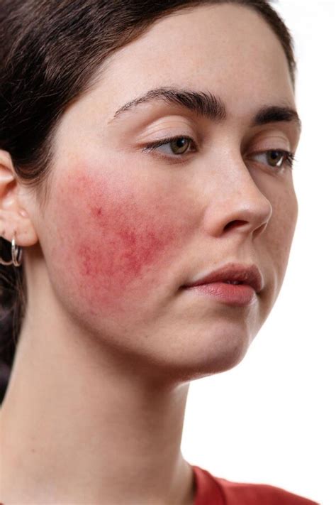 4 Types of Rosacea + Natural Treatments | The Rosacea Method