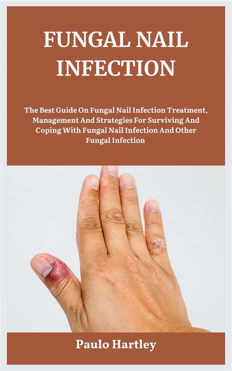 FUNGAL NAIL INFECTION: The Best Guide On Fungal Nail Infection Treatment, Management And ...