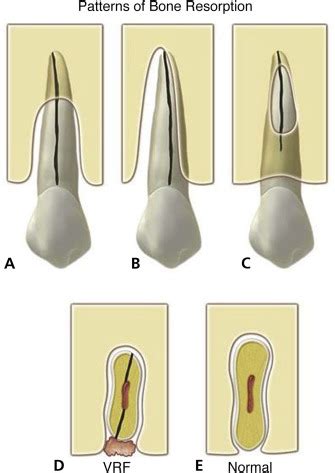 Vertical root fracture - The Journal of the American Dental Association