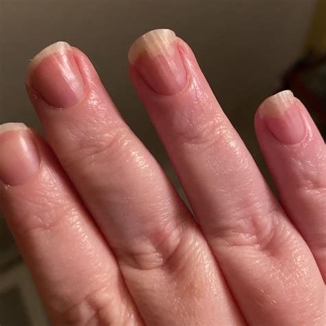 One month progress with Nail Mycosis. If I knew how to post the before ...