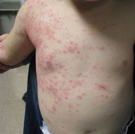 Toddler with a Worsening Rash | AAFP