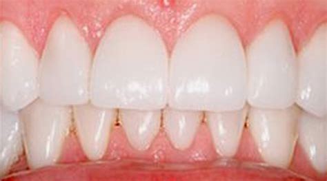 Teeth Whitening Houston - Bellaire Modern Dental | Houston, TX