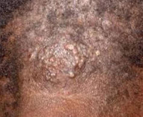 Ingrown Hair Bumps On Scalp