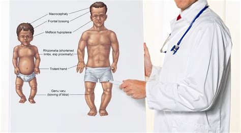 Achondroplasia | Causes, Signs, Standard Therapies, Prevention in children & More - Page 6 of 16 ...