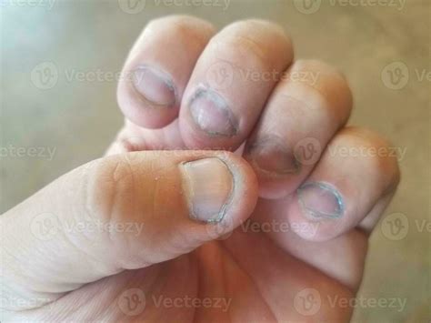 bitten and dirty fingernails 8199882 Stock Photo at Vecteezy