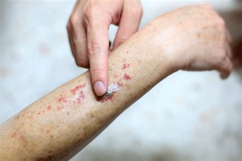 Causes, Symptoms and Treatments for Petechiae | Banner Health