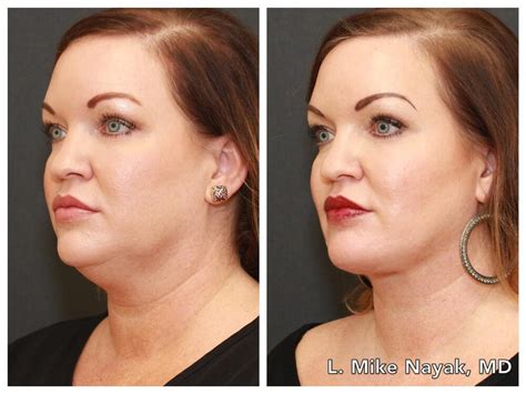 Before & After Buccal Fat Removal Procedures in St. Louis MO | Nayak