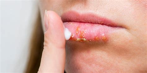 Sunburned Lips: How to Treat a Lip Burn