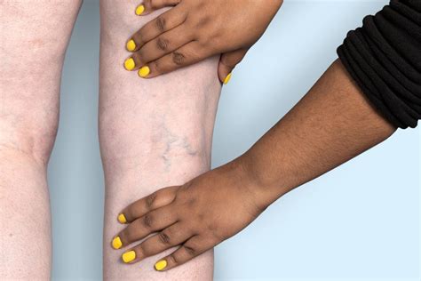 What Your Blue, Green, or Purple Veins Are Telling You | Metro Vein Centers