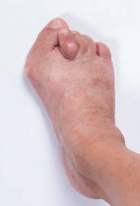 Bunions – Welcome to sorefeet.co.uk :: Home of the Chingford and ...