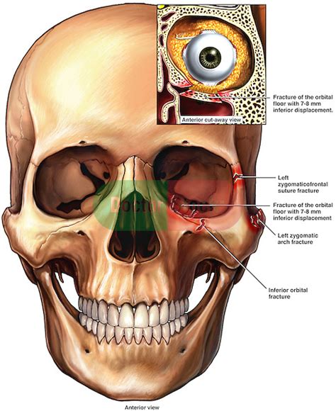 Orbital blowout fracture - fukiza