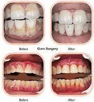 Gum Surgery at best price in Raipur | ID: 7875950162