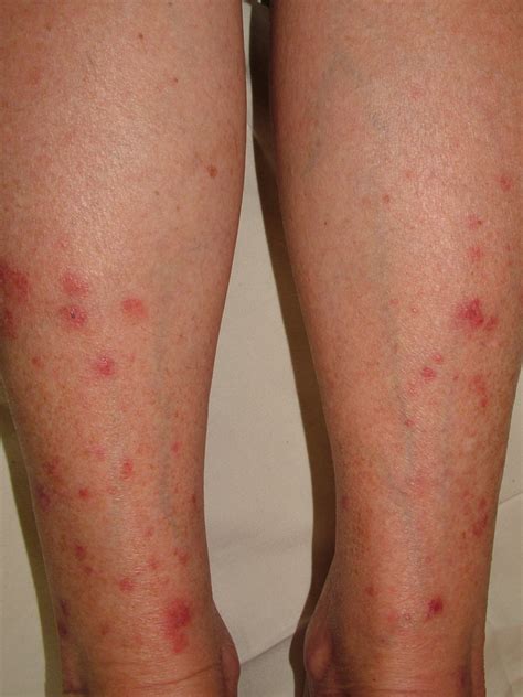 [Figure, Papular polymorphic light eruption on lower legs in female DermNet New Zealand ...