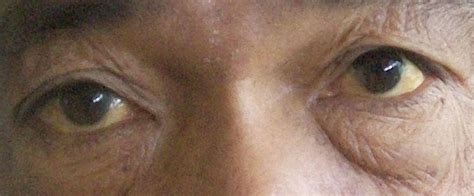 Yellow Eyes (Jaundice Eyes): Causes, Symptoms & Treatments