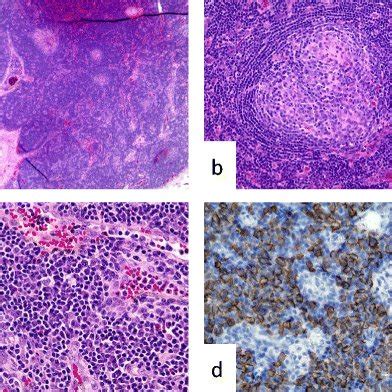 Pathological findings of the cervical lymph node biopsy. a Lymph node... | Download Scientific ...