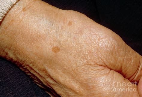 Liver Spots On The Hand Of An Elderly Woman Photograph by Jane Shemilt, Cosine Graphics/science ...