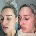 Products to use before + after chemical peels in dubai