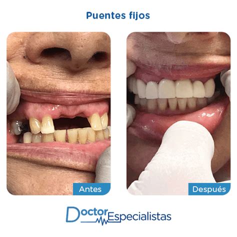 Mejores Clinicas Dentales Para Puentes Fijos | Doctor Especialistas