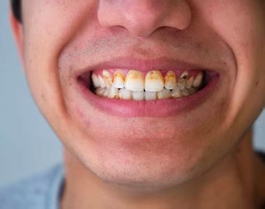 Methamphetamine : The Devastating Effects of Meth Mouth | Arch Dental ...