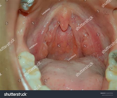 Healthy tonsil : 1 053 photos et images de stock | Shutterstock