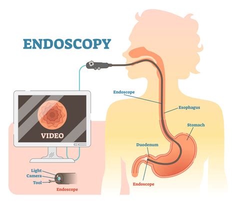 How Much Does It Cost For An Endoscopy In Singapore? – You’d Be Surprised!