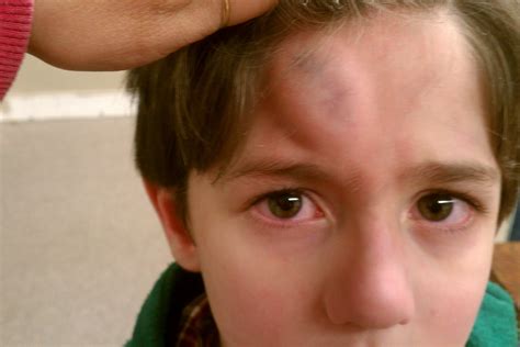 Head injuries in children: a study correlates trauma and effects