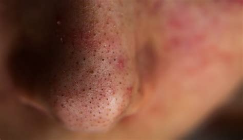 Blackheads: What They Look Like, Treatment & Prevention