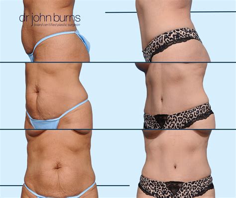 The Dallas Tummy Tuck- Mommy Makeover Aesthetic- Dr. John Burns – Dr ...