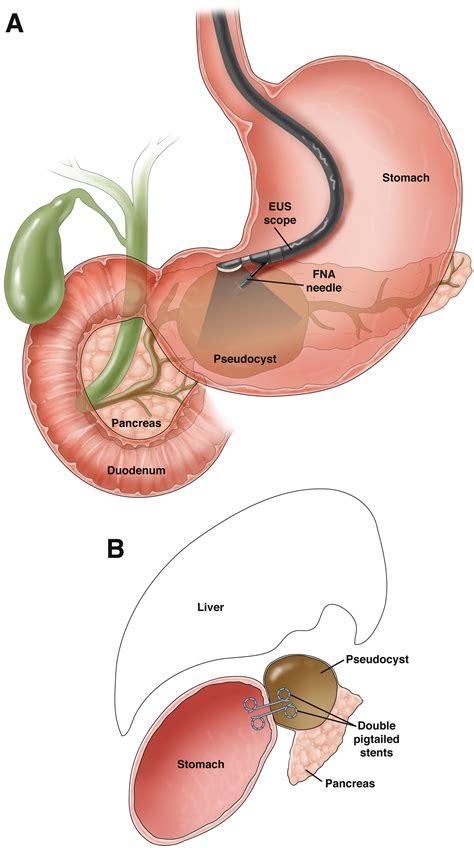 Evidence-Based Treatment of Pancreatic Pseudocysts - Gastroenterology