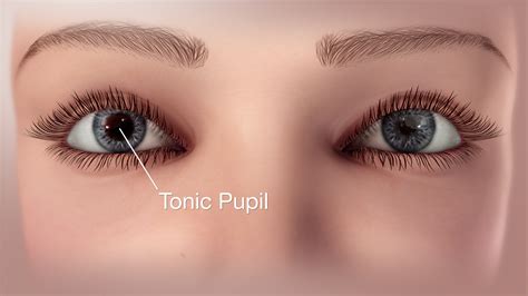 Tonic Pupil Syndrome Illustrated Using A 3D Medical, 59% OFF