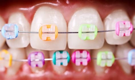 Orthodontics Rubber Bands Stock Photos Free Royalty-Free Stock Photos From Dreamstime | atelier ...