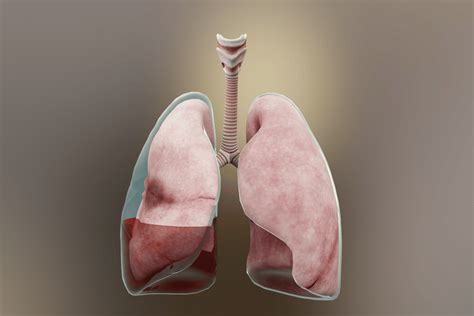 Pleural Effusion