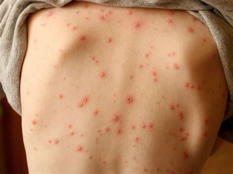 Skin rash should be considered key symptom of coronavirus, say ...