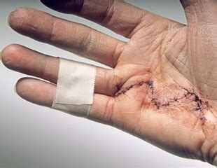 Dupuytren's Contracture Surgery and Recovery