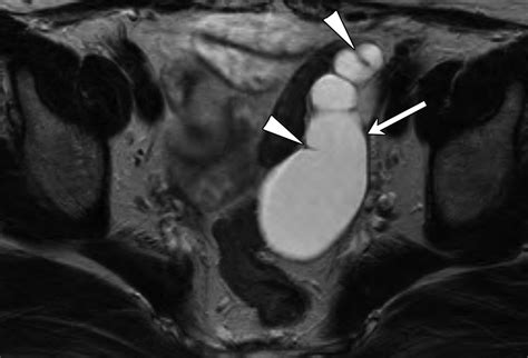 MR Imaging Findings of Hydrosalpinx: A Comprehensive Review | RadioGraphics