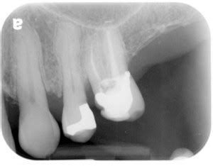 Hypercementosis – Dr. G's Toothpix